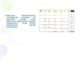 Detrusor kontraksiyonu yokluğunda valsalva ile eşzamalı olarak idrar kaçımının gözlenmesi  gerçek (anatomik)  stres üriner inkontinans  olarak yorumlanır. 