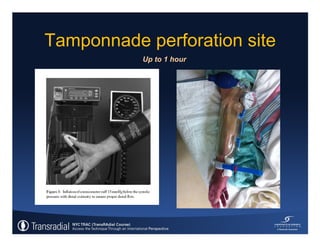Rinfret S - Case of bleeding, compartment syndrome