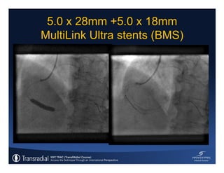 Rinfret S - Case of bleeding, compartment syndrome