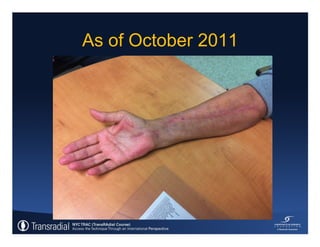 Rinfret S - Case of bleeding, compartment syndrome