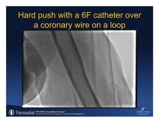 Rinfret S - Case of bleeding, compartment syndrome