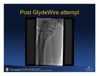 Rinfret S - Case of bleeding, compartment syndrome