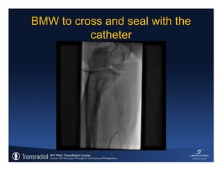 Rinfret S - Case of bleeding, compartment syndrome
