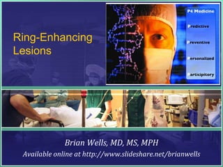 Ring-Enhancing
Lesions
Brian Wells, MD, MS, MPH
Available online at http://www.slideshare.net/brianwells
 