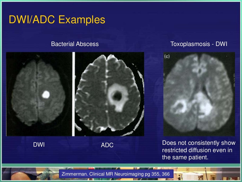 Ring Enhancing Lesions