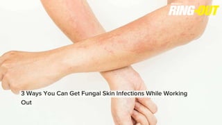 3 Ways You Can Get Fungal Skin Infections While Working Out