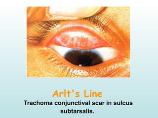 Arlt's Line
Trachoma conjunctival scar in sulcus
subtarsalis.
 