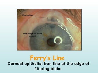 Ferry’s Line
Corneal epithelial iron line at the edge of
filtering blebs
 