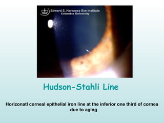 Hudson-Stahli Line
Horizonatl corneal epithelial iron line at the inferior one third of cornea
due to aging.
 