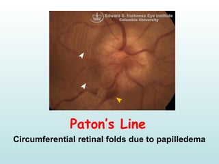 Paton’s Line
Circumferential retinal folds due to papilledema
 