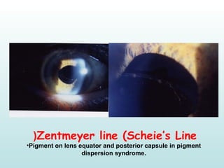 Zentmeyer line (Scheie’s Line(
•Pigment on lens equator and posterior capsule in pigment
dispersion syndrome.
 