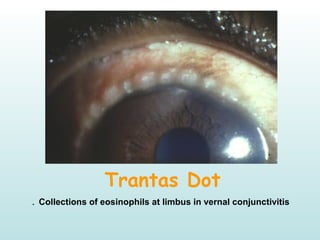 Trantas Dot
Collections of eosinophils at limbus in vernal conjunctivitis.
 