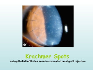 Krachmer Spots
subepithelial infiltrates seen in corneal stromal graft rejection
 