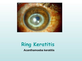 Ring Keratitis
Acanthamoeba keratitis
 