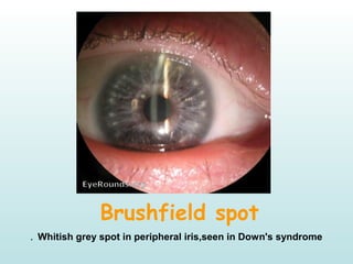Brushfield spot
Whitish grey spot in peripheral iris,seen in Down's syndrome.
 