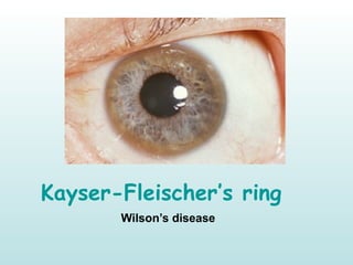 Kayser-Fleischer’s ring
Wilson’s disease
 