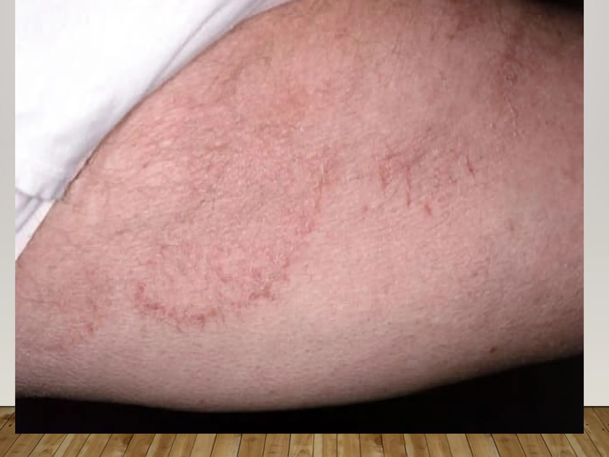 RingWorm Ringworm is a common fungal infection also known as Tinea | PPTX