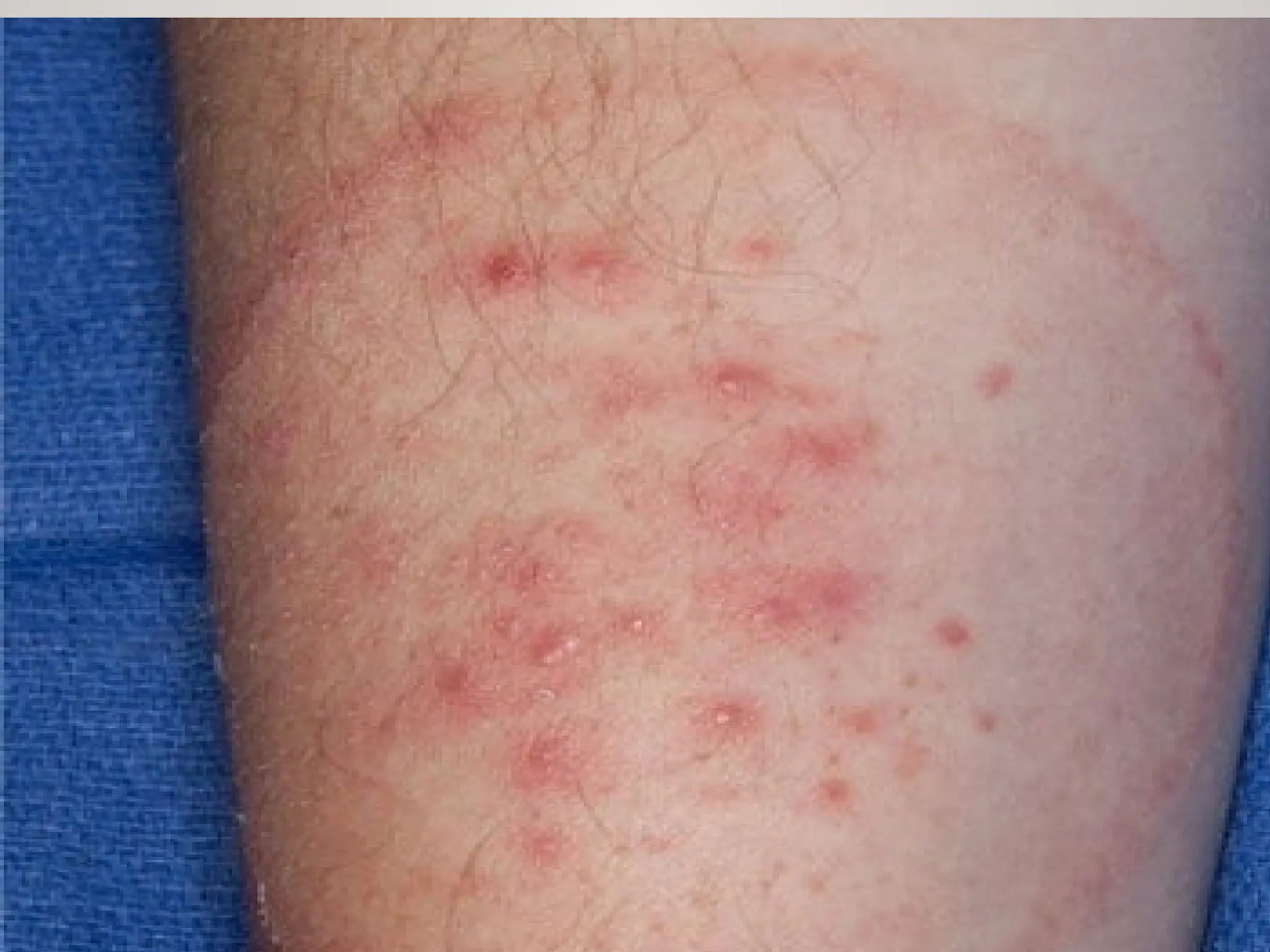 RingWorm Ringworm is a common fungal infection also known as Tinea | PPTX