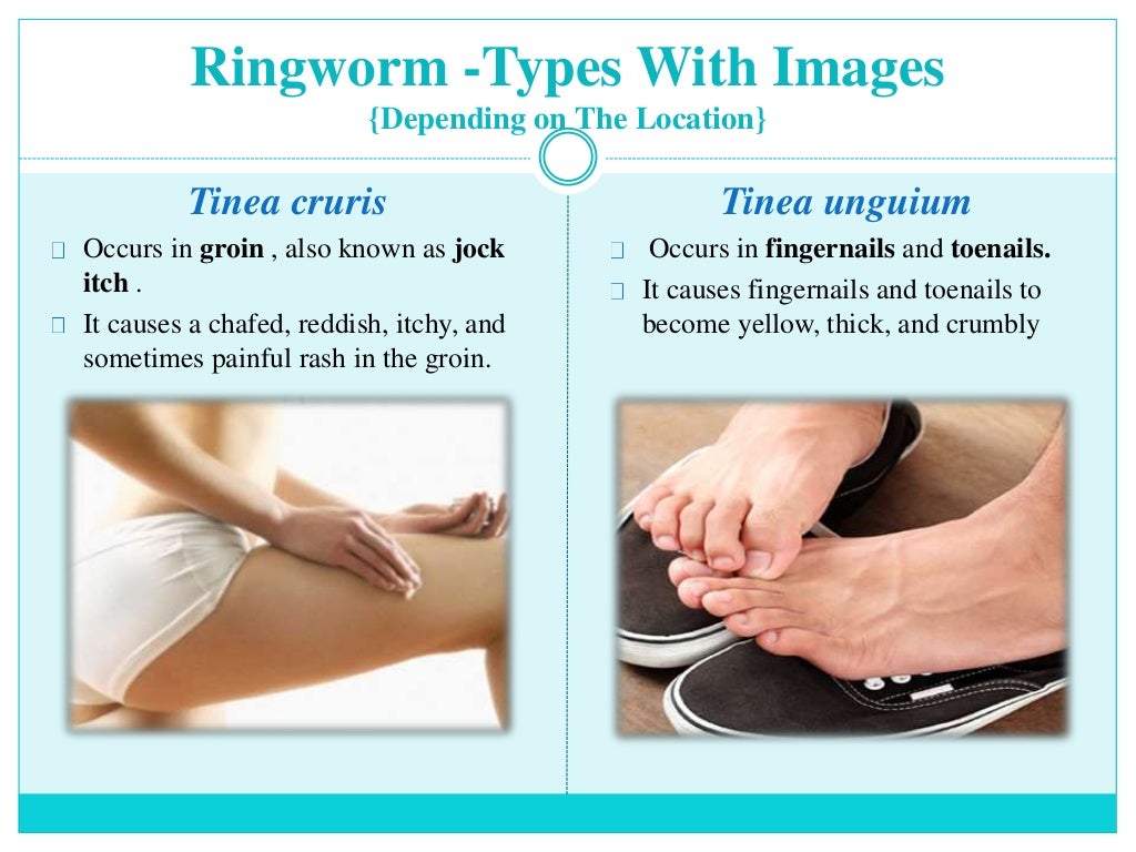 Ringworm in Athletes