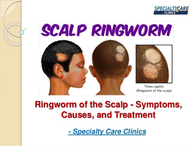 Ringworm of the Scalp - Symptoms,
Causes, and Treatment
- Specialty Care Clinics
 