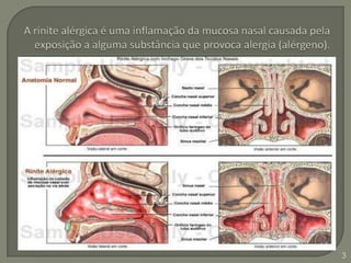A rinite alérgica é uma inflamação da mucosa nasal causada pela exposição a alguma substância que provoca alergia (alérgeno). 3