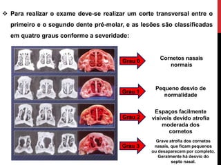  Para realizar o exame deve-se realizar um corte transversal entre o
primeiro e o segundo dente pré-molar, e as lesões são classificadas
em quatro graus conforme a severidade:
Grau 0
Grau 1
Grau 2
Grau 3
Pequeno desvio de
normalidade
Espaços facilmente
visíveis devido atrofia
moderada dos
cornetos
Cornetos nasais
normais
Grave atrofia dos cornetos
nasais, que ficam pequenos
ou desaparecem por completo.
Geralmente há desvio do
septo nasal.
 