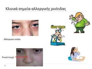 Κλινικά ςθμεία αλλεργικισ ρινίτιδασ




 Αλλεργικοί κφκλοι




΢ινικι πτυχι
 