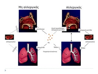 Μη αλλεργικός                                        Αλλεργικός




                                              Κοινό κρσολόγημα ?
                          κρσολόγημα
                                              Αλλεργική ρινίηιδα?           Aλλεργική ρινίηιδα




αλλεργιογόνο                                                                          αλλεργιογόνο
                                        ιός


                           βρογτίηιδα            Άζθμα x
                                                                              Άζθμα

                                  Υπεραπανηηηικόηηηα
 