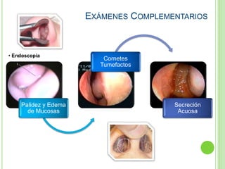 EXÁMENES COMPLEMENTARIOS
Palidez y Edema
de Mucosas
Cornetes
Tumefactos
Secreción
Acuosa
• Endoscopía
 