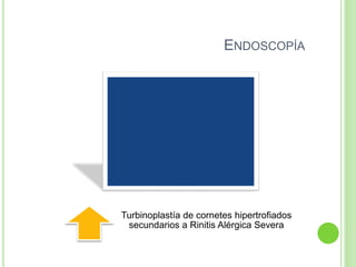 ENDOSCOPÍA
Turbinoplastía de cornetes hipertrofiados
secundarios a Rinitis Alérgica Severa
 