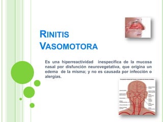 RINITIS
VASOMOTORA
Es una hiperreactividad inespecífica de la mucosa
nasal por disfunción neurovegetativa, que origina un
edema de la misma; y no es causada por infección o
alergias.
 