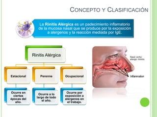 CONCEPTO Y CLASIFICACIÓN
La Rinitis Alérgica es un padecimiento inflamatorio
de la mucosa nasal que se produce por la exposición
a alergenos y la reacción mediada por IgE.
Rinitis Alérgica
Estacional
Ocurre en
ciertas
épocas del
año.
Perenne
Ocurre a lo
largo de todo
el año.
Ocupacional
Ocurre por
exposición a
alergenos en
el trabajo.
 