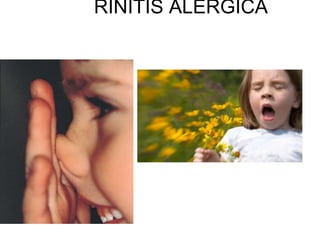 RINITIS ALERGICA 