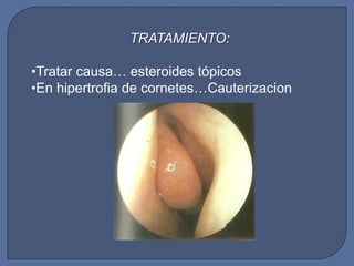 TRATAMIENTO:

•Tratar causa… esteroides tópicos
•En hipertrofia de cornetes…Cauterizacion
 