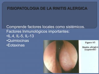 FISIOPATOLOGIA DE LA RINITIS ALERGICA



Comprende factores locales como sistémicos.
Factores Inmunológicos importantes:
•IL.4, IL-5, IL-13
•Quimiocinas
•Eotaxinas
 