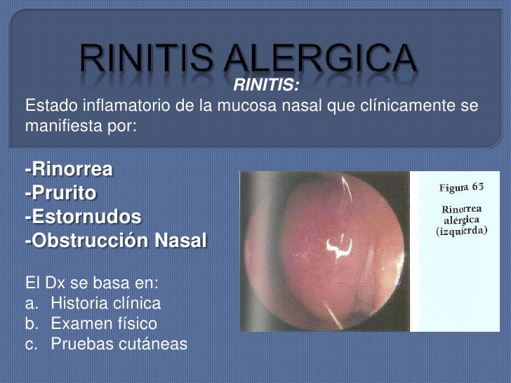 Rinitis alergica Rinitis alergica