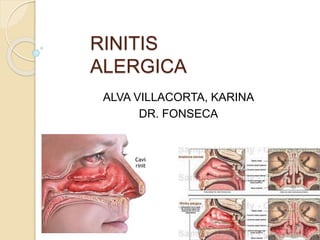 RINITIS
ALERGICA
ALVA VILLACORTA, KARINA
DR. FONSECA
 