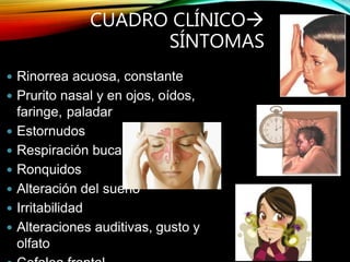 CUADRO CLÍNICO
SÍNTOMAS
 Rinorrea acuosa, constante
 Prurito nasal y en ojos, oídos,
faringe, paladar
 Estornudos
 Respiración bucal
 Ronquidos
 Alteración del sueño
 Irritabilidad
 Alteraciones auditivas, gusto y
olfato
 