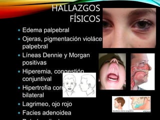 HALLAZGOS
FÍSICOS
 Edema palpebral
 Ojeras, pigmentación violácea
palpebral
 Líneas Dennie y Morgan
positivas
 Hiperemia, congestión
conjuntival
 Hipertrofia cornetes uni o
bilateral
 Lagrimeo, ojo rojo
 Facies adenoidea
 