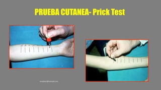 PRUEBA CUTANEA- Prick Test
ematben@hotmail.com
 