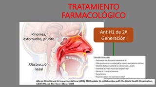 TRATAMIENTO
FARMACOLÓGICO
AntiH1 de 2ª
Generación
Esteroides
nasales
Rinorrea,
estornudos, prurito
Obstrucción
nasal
 