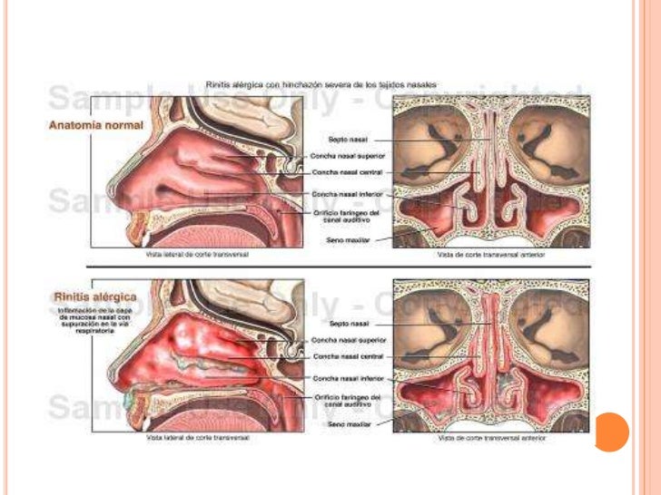 Rinitis alergica y no alergica Rinitis alergica y no alergica
