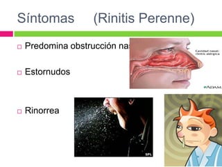 Síntomas (Rinitis Perenne)
 Predomina obstrucción nasal
 Estornudos
 Rinorrea
 