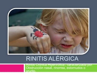 RINITIS ALÉRGICA
Rinitis Crónica Hipertrófica:, caracterizada por:
Obstrucción nasal, rinorrea, estornudos o
prurito.
 