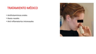TRATAMIENTO MÉDICO
• Antihistamínicos orales
• Aseos nasales
• Anti-inflamatorios intranasales
 