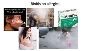 Rinitis no alérgica.
 