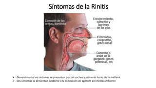 Síntomas de la Rinitis
 Generalmente los síntomas se presentan por las noches y primeras horas de la mañana.
 Los síntomas se presentan posterior a la exposición de agentes del medio ambiente
 