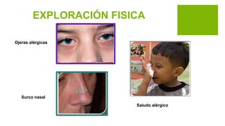 EXPLORACIÓN FISICA
Ojeras alérgicas
Saludo alérgico
Surco nasal
 