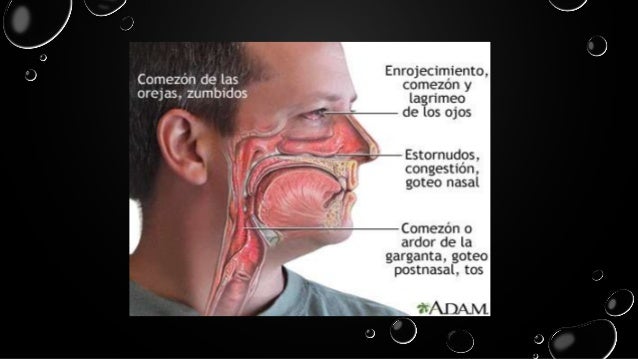 Sinusitis Rinitis O Sinusitis Rinitis O