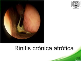RLNRLN
Rinitis crónica atrófica
 